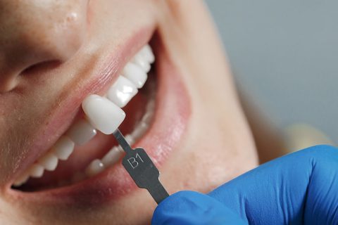 Facetas Dentárias